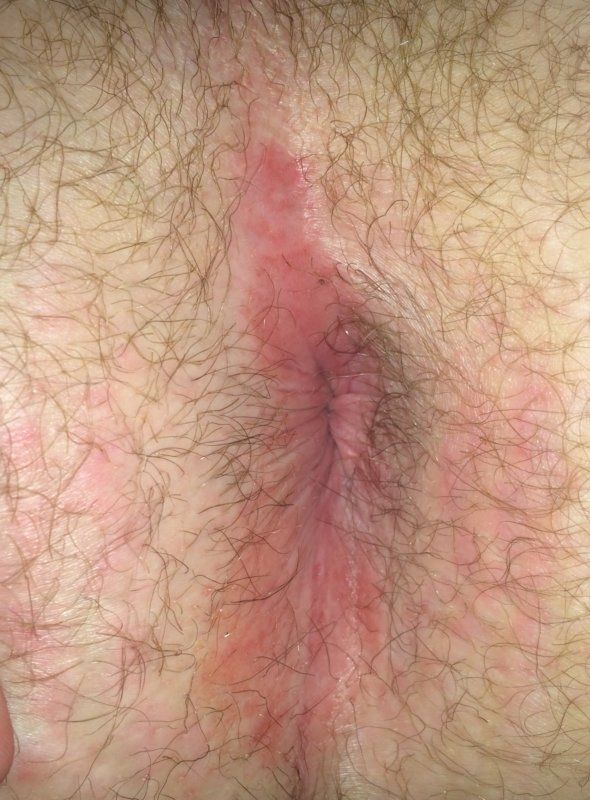 best of Wall rash Anus