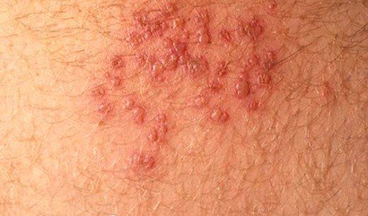 best of Wall rash Anus